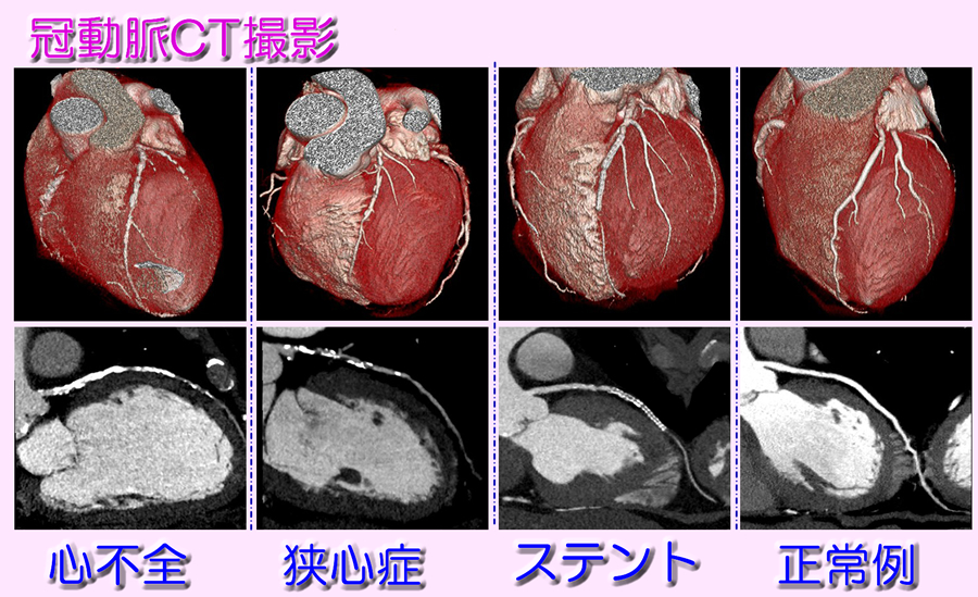 冠動脈CT画像