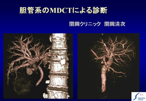 胆管系のMDCTによる診断