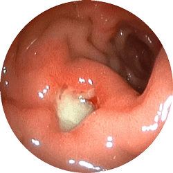 十二指腸潰瘍2
