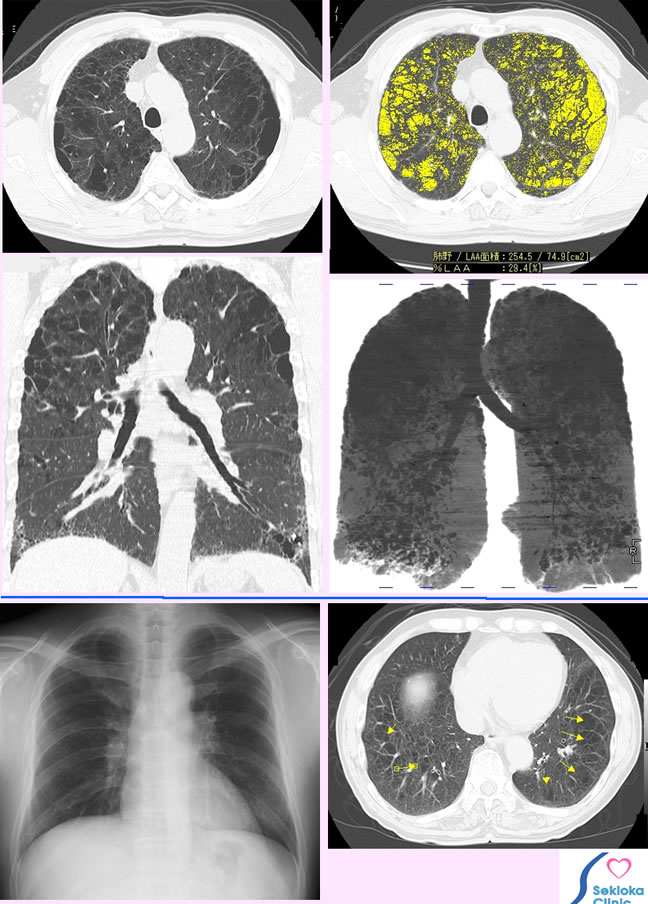 肺気腫　MDCT診断画像