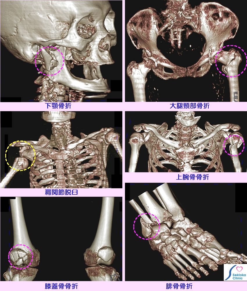 種々の骨折　MDCT画像