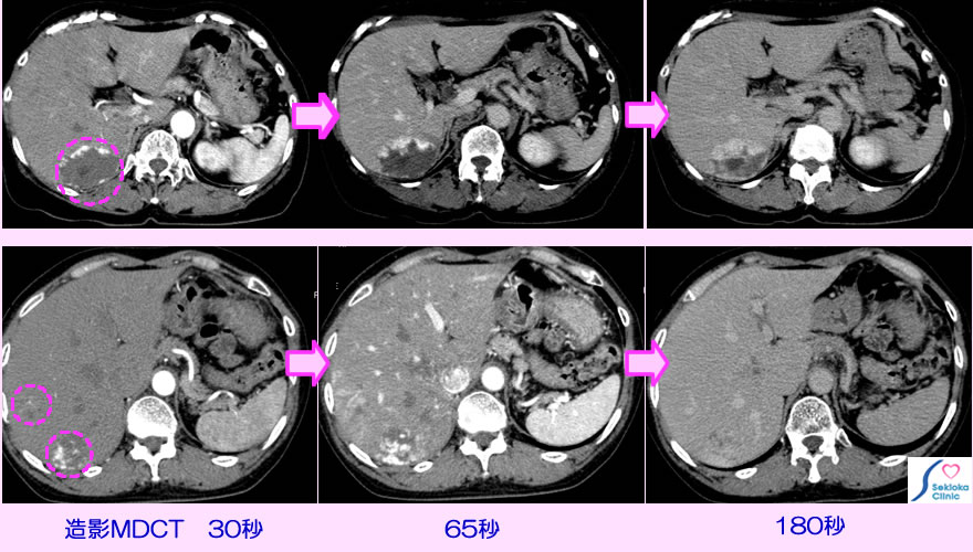 肝血管腫　CT画像