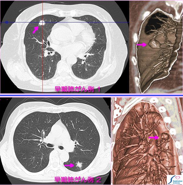 肺がん早期例　MDCT画像