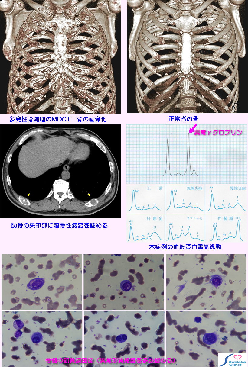 多発性骨髄腫　診断画像