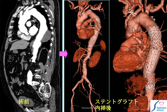 胸部動脈瘤ステントグラフト内挿術