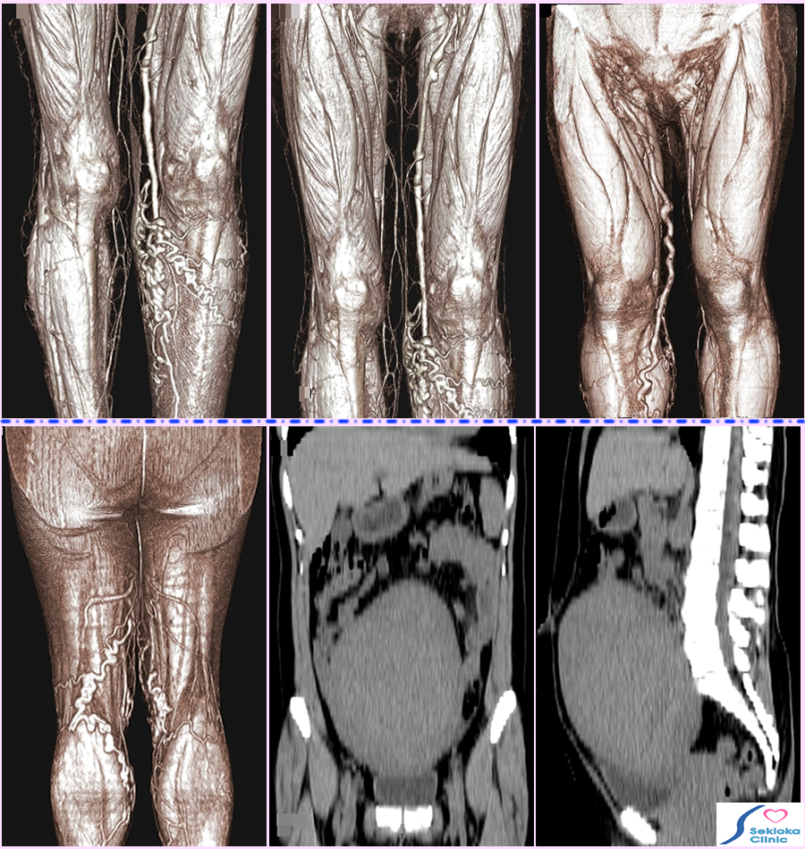 下肢静脈瘤　MDCT画像